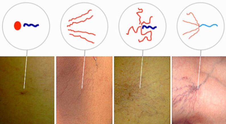 Spider veins in the initial stage of varicose veins