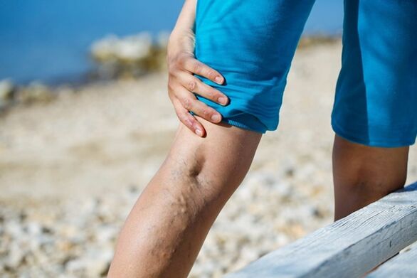 Shooting pain in legs with varicose veins