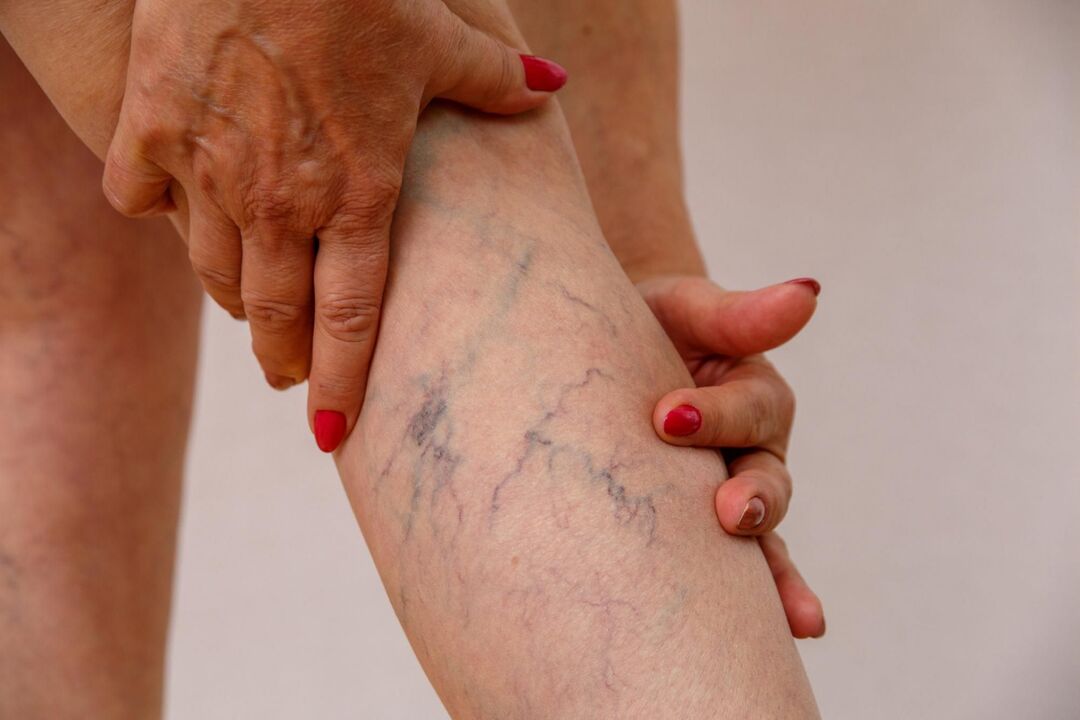 varicose veins of the legs