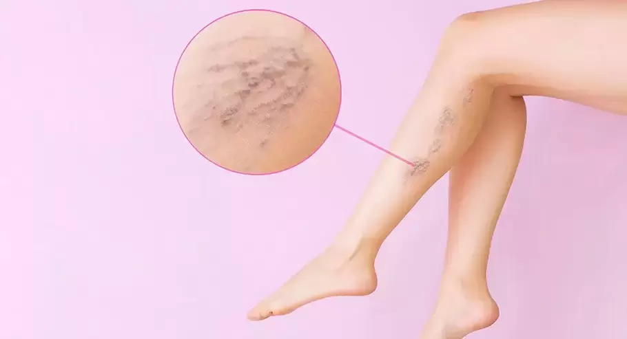 Curved bulging veins on the legs with varicose veins