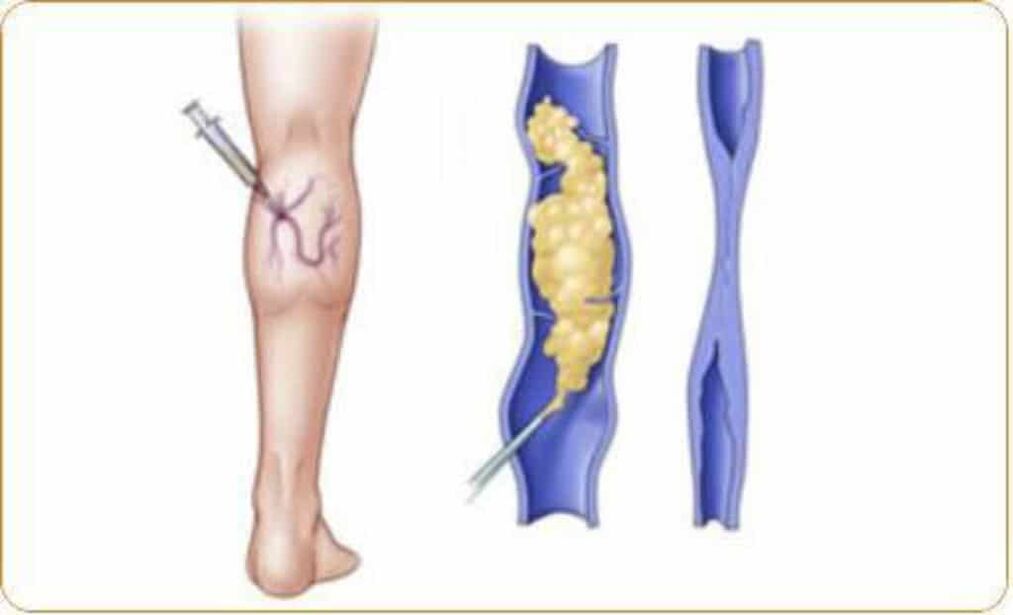 An example of a sclerotherapy procedure for varicose veins and a clear result