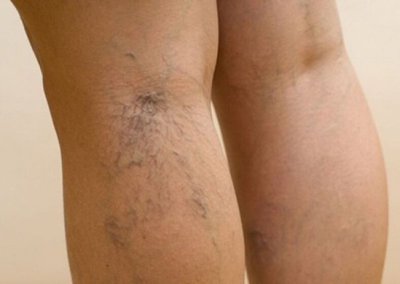 The beginning of the development of varicose veins of the legs